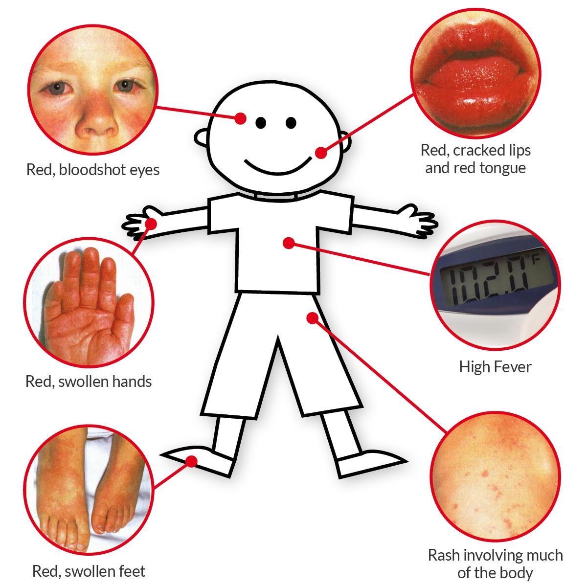 Kawasaki Disease linked to  COVID-19 in Kids